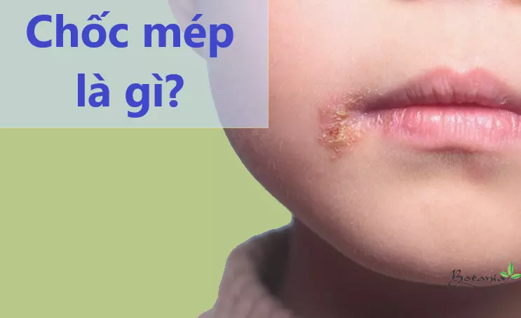 Bệnh chốc mép là gì?